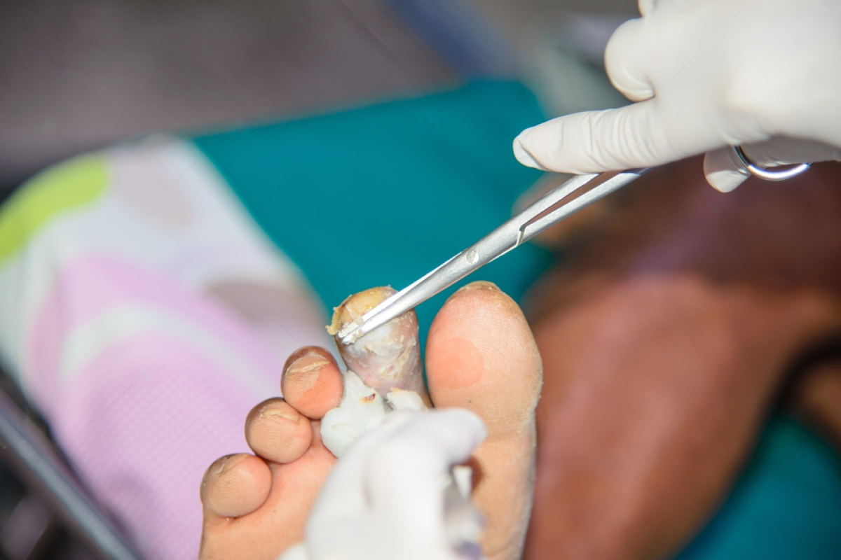 Orthopedic Treatment for Necrotic Foot Restoring Health and Mobility