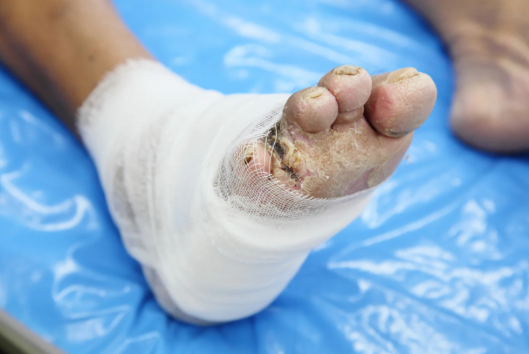 Orthopedic Treatment for Diabetic Foot Disease