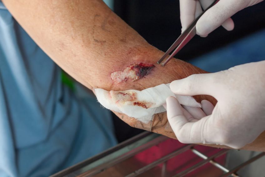 Advanced wound debridement Philippines