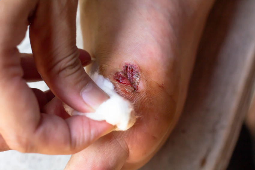 Philippine wound debridement experts