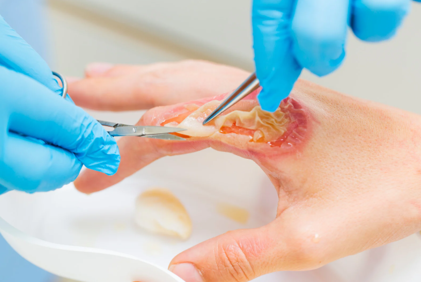 Wound debridement Philippines Photo