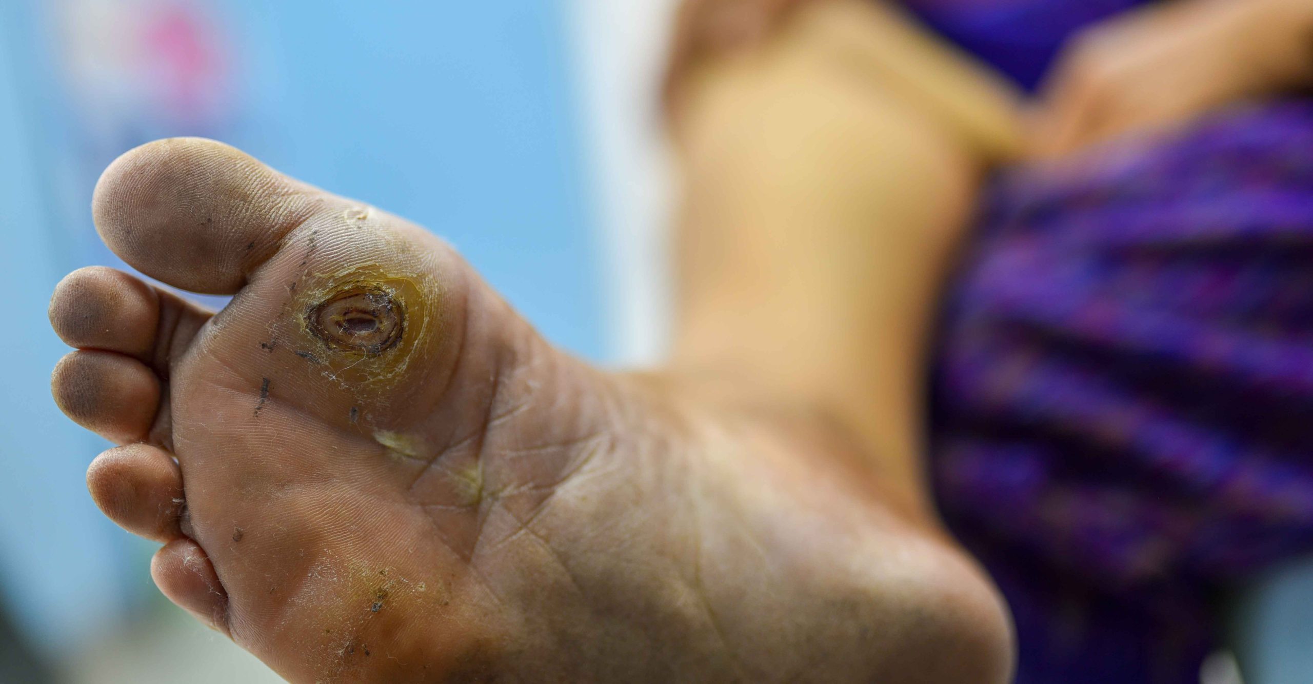 Effective Strategies for Diabetic Foot Ulcer Management