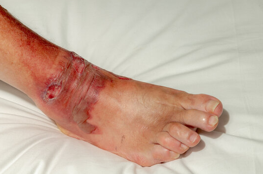 2nd degree burn wound care