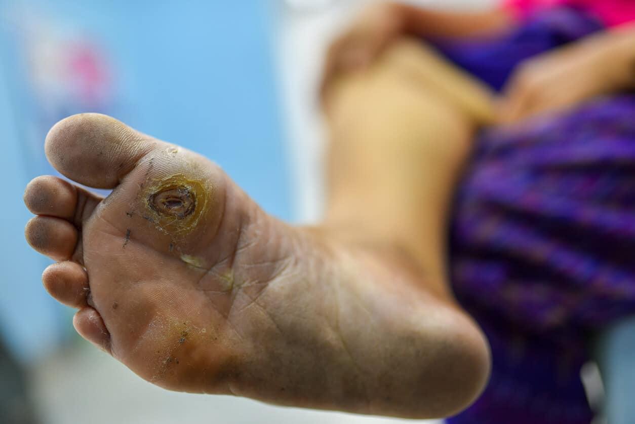 Diabetic Gangrene and Orthopedic Solutions Saving Limbs and Restoring Mobility